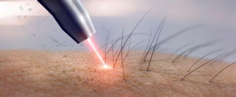 Laser Hair Removal