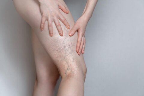 Sclerotherapy