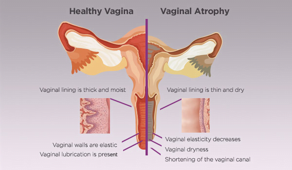 Vaginal Atrophy