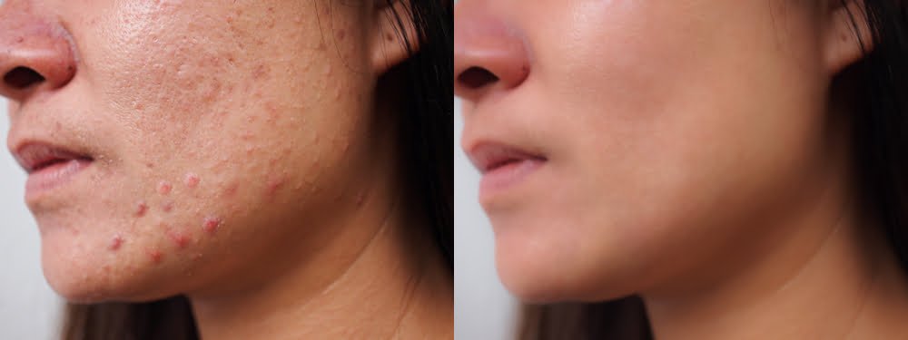 Acne before and after