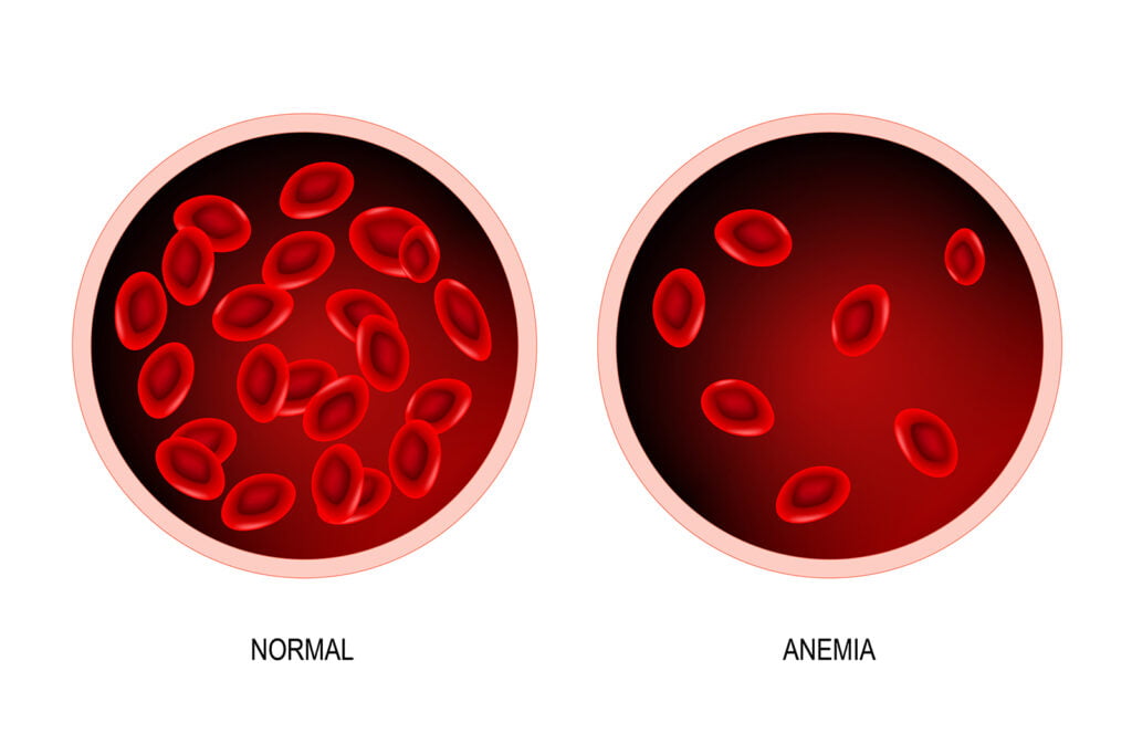 iron deficiency anemia