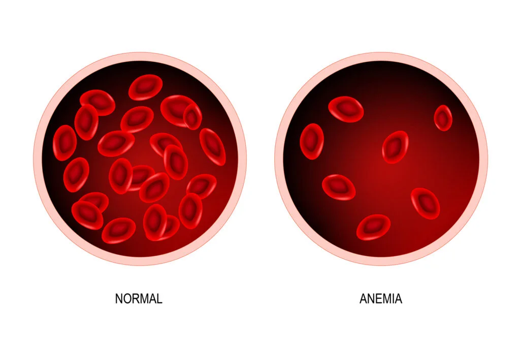 iron deficiency anemia